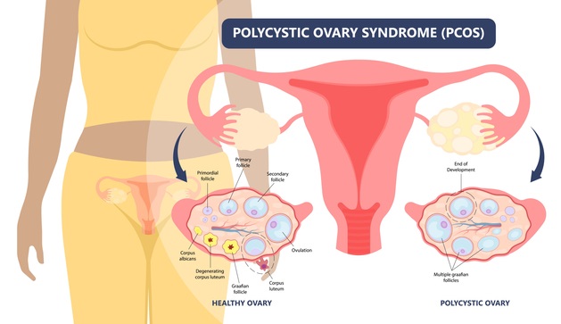 Getting Pregnant with Polycystic Ovaries (PCOS) and PCOD