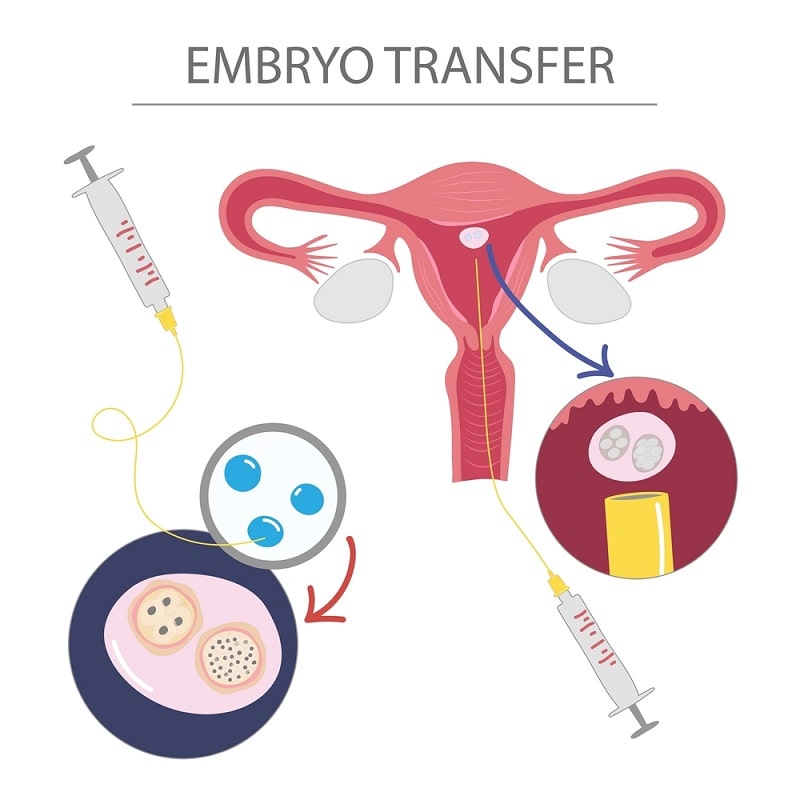What is an Embryo Transfer