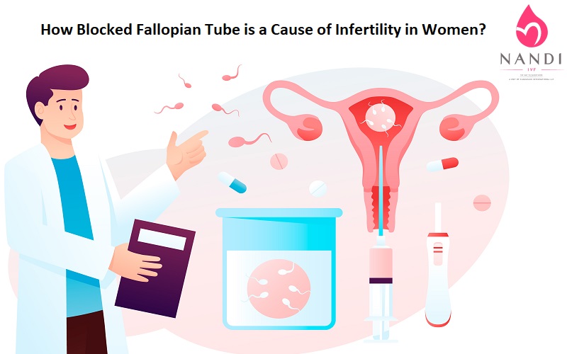 Blocked Fallopian Tube is a Cause of Infertility in Women